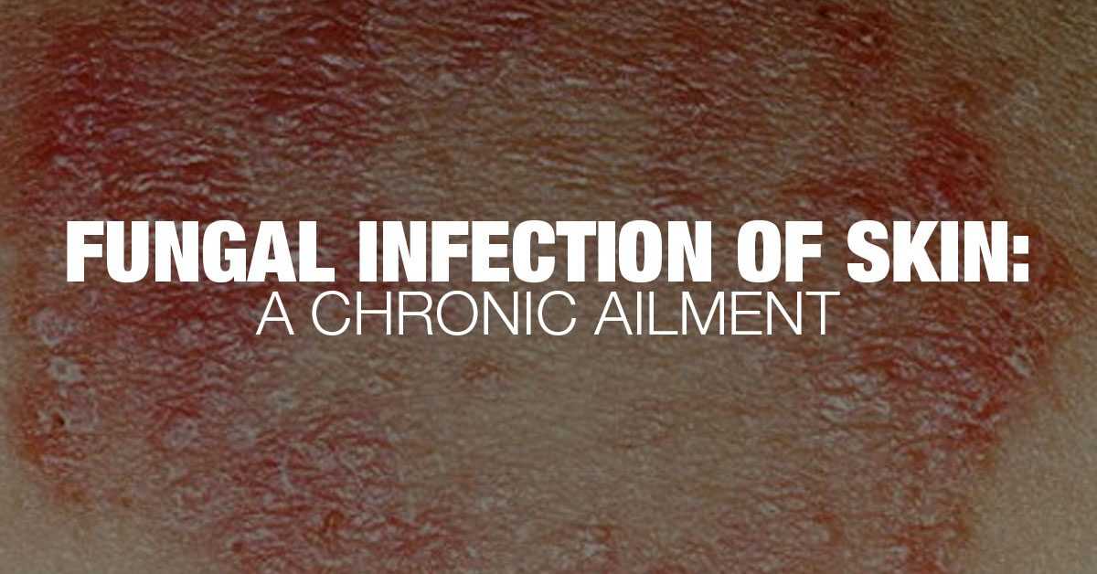 What Are Fungal Infections Of The Skin? Know The Facts!