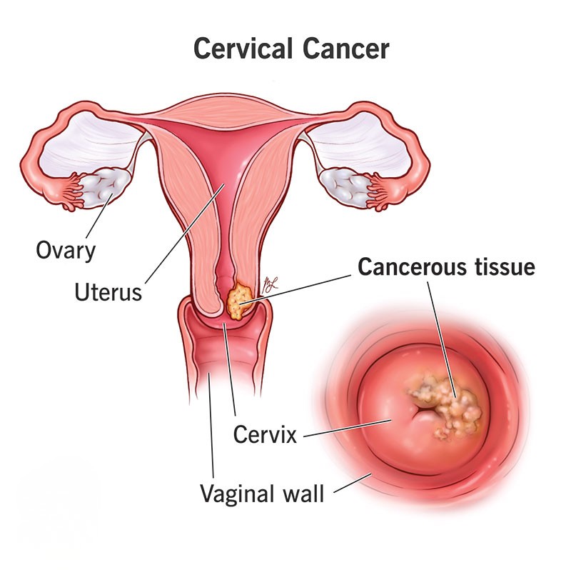 Cervical Cancer 