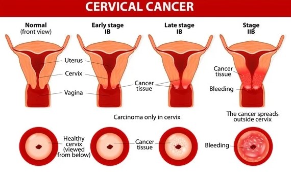 Cervical Cancer Stages