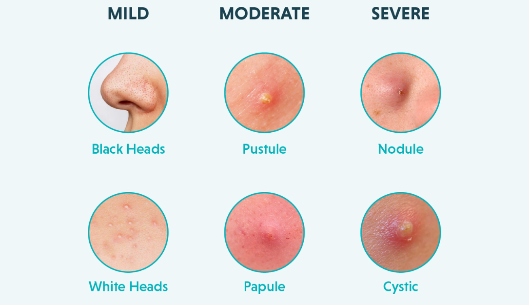 Acne Symptoms
