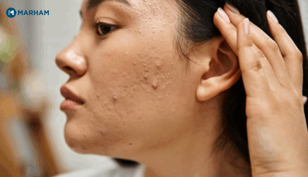 Acne Treatment in Pakistan