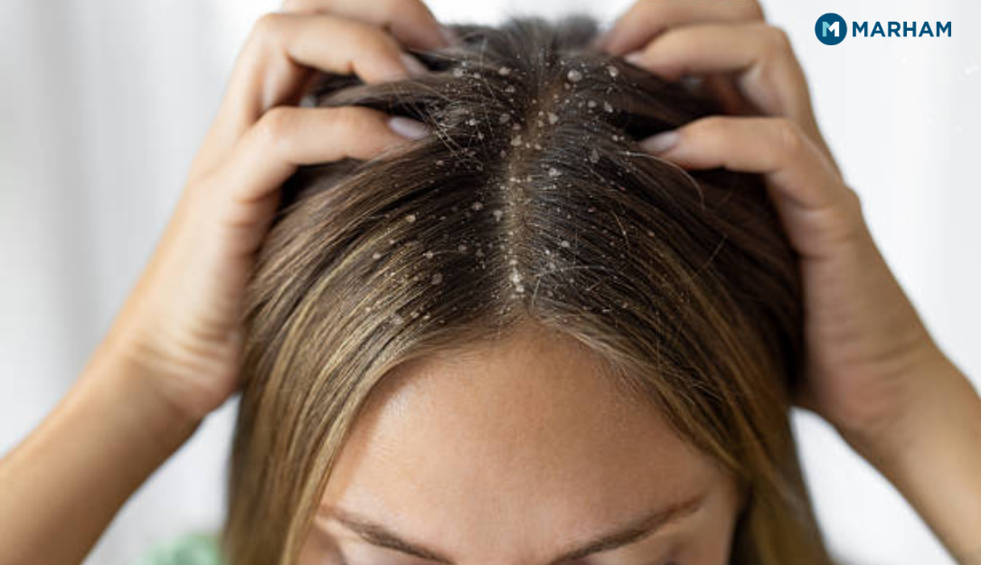 Treatment for Dandruff