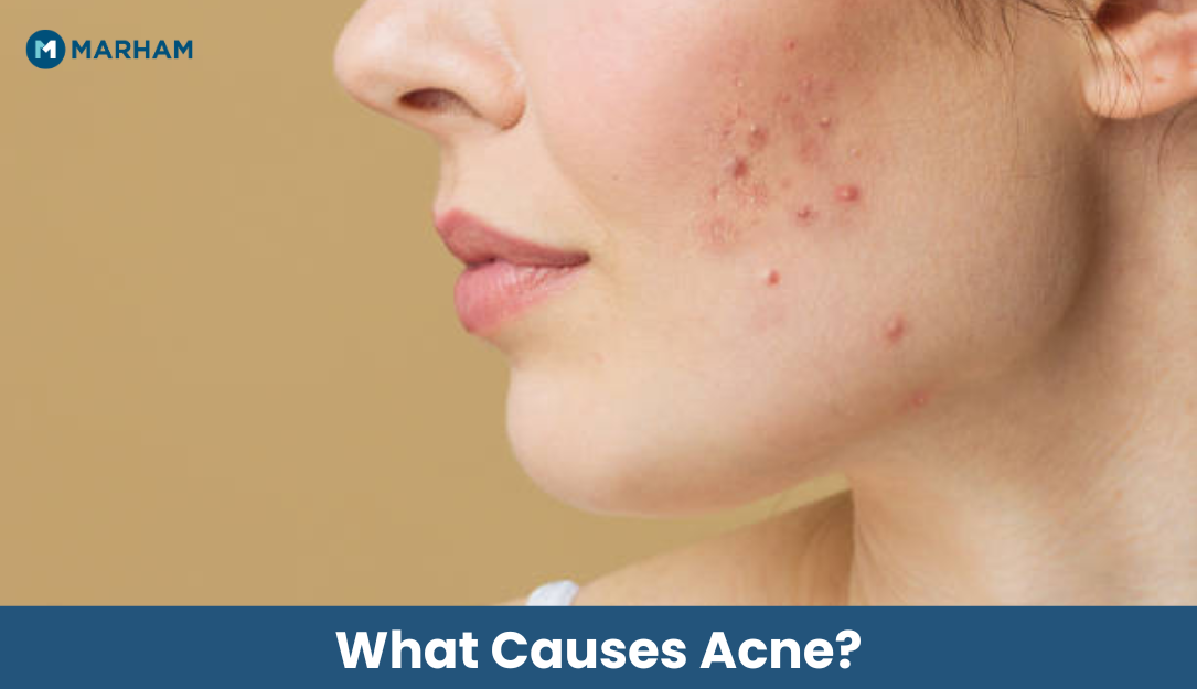 What Causes Acne