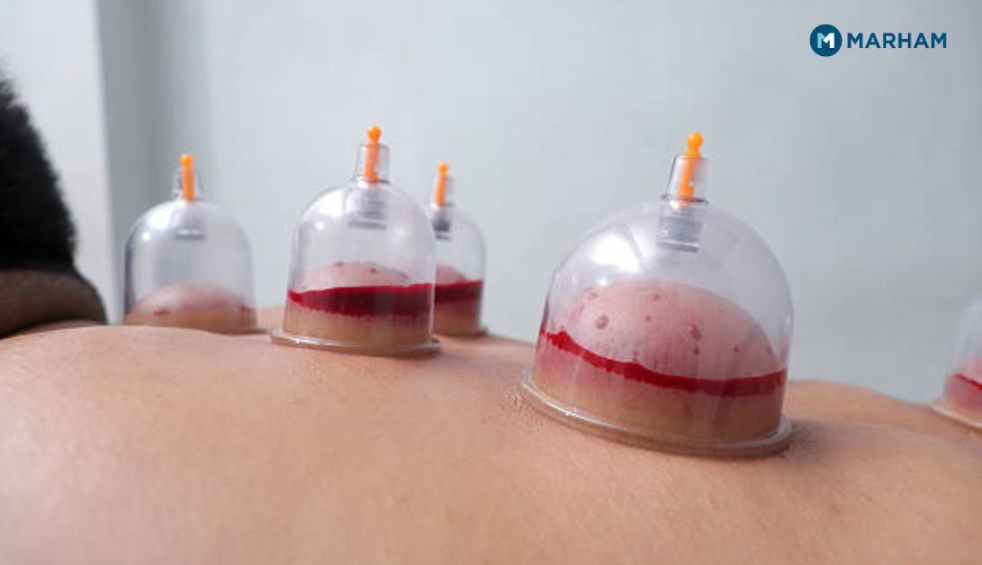 Hijama Benefits