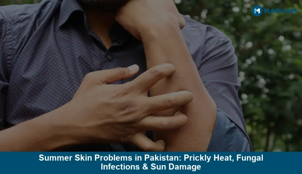 Summer Skin Problems in Pakistan: Prickly Heat, Fungal Infections & Sun Damage