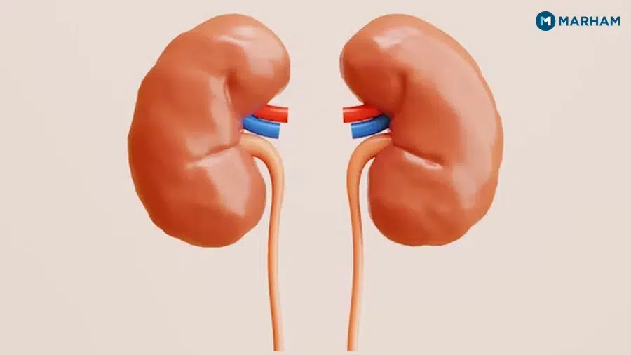 What Are Kidney Stones and Why Are They Common in Pakistan?