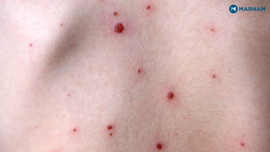 Breakthrough Chickenpox After Vaccination