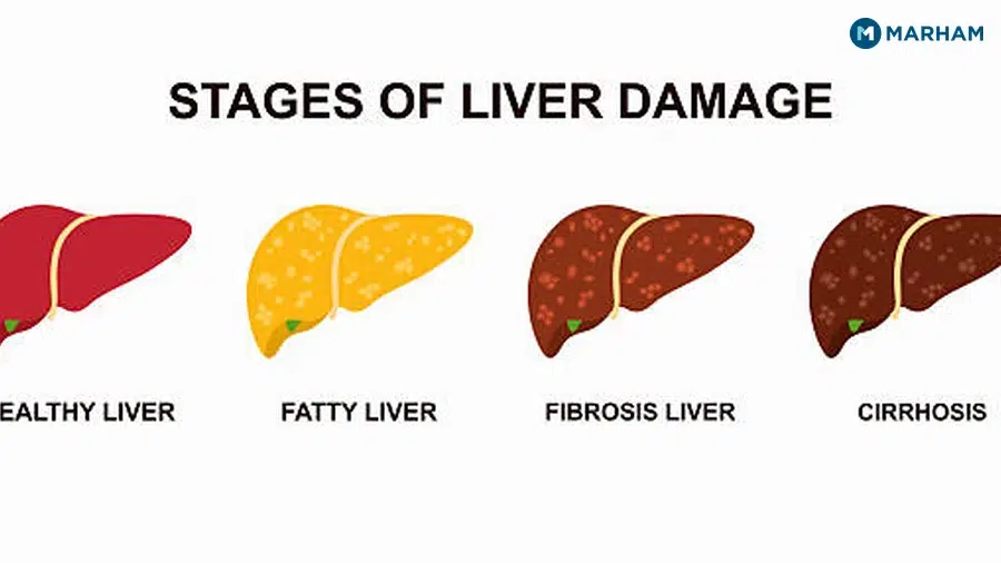 Fatty Liver Symptoms in Pakistan: What Patients Actually Report
