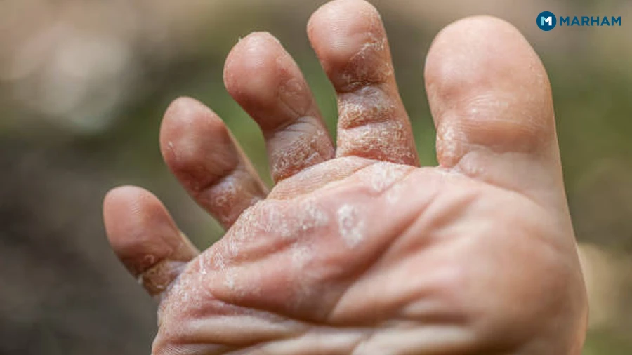 گرمیوں میں جلد کی فنگل انفیکشن | Garmiyon Mein Jild Ki Fungal Infection