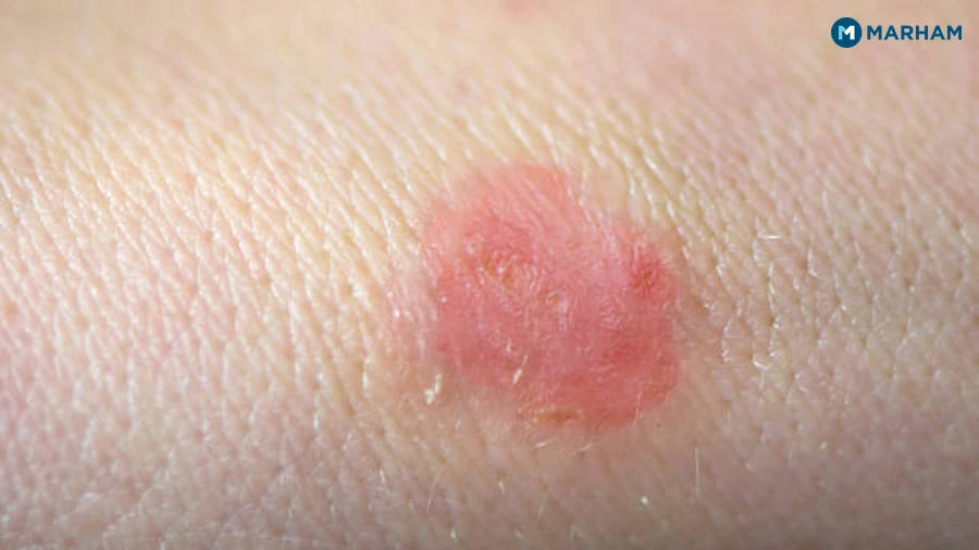 Symptoms of Fungal Infection on Skin: What to Look For
