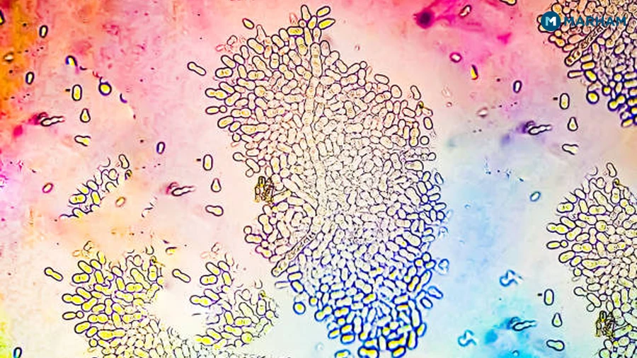 When Does a Fungal Infection Need a Doctor?