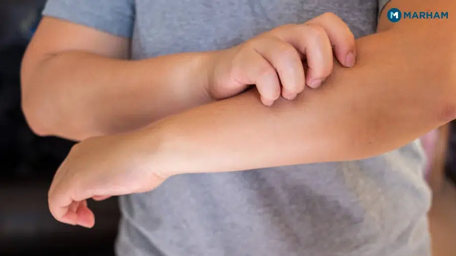2. Dry Skin