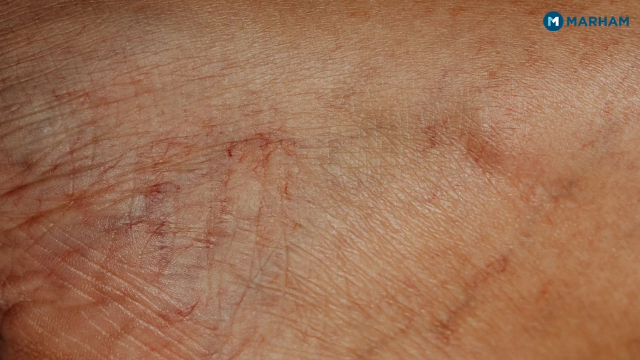 4. Deep Vein Thrombosis (DVT) and Blood Clots