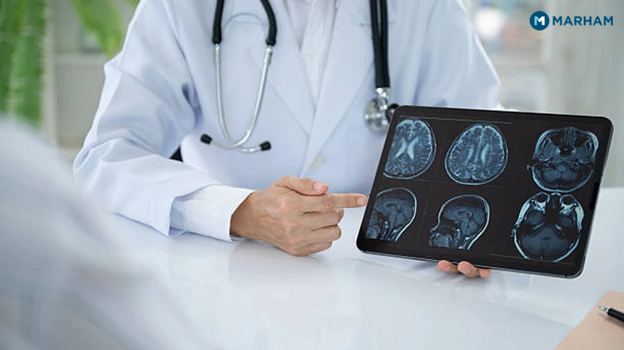Focal Seizures: When Only Part of the Brain Is Involved