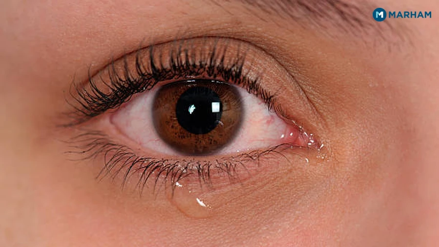 How to Treat Watery Eyes at Home