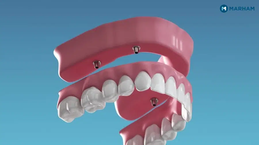 Implants vs Dentures Cost in Pakistan (2026)