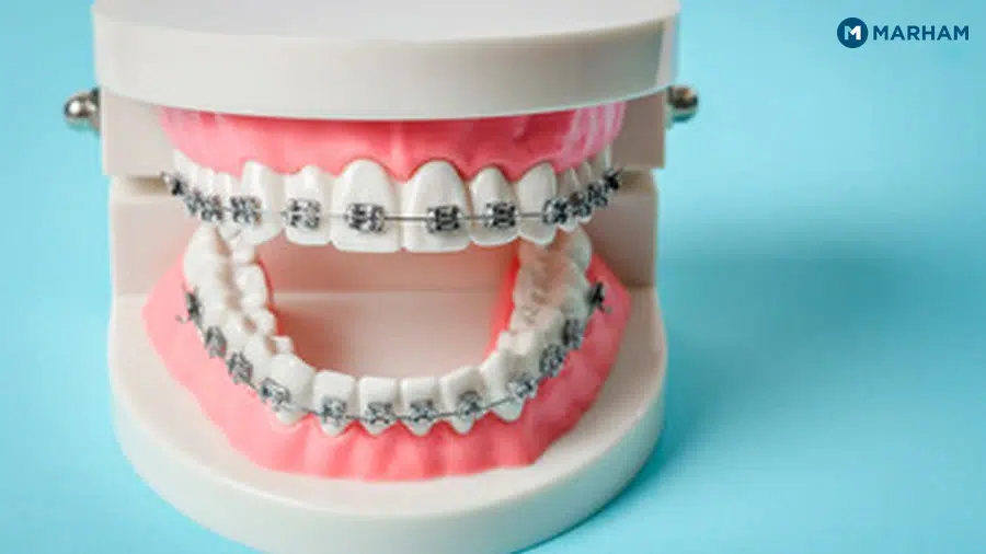 What Are Ceramic Braces?