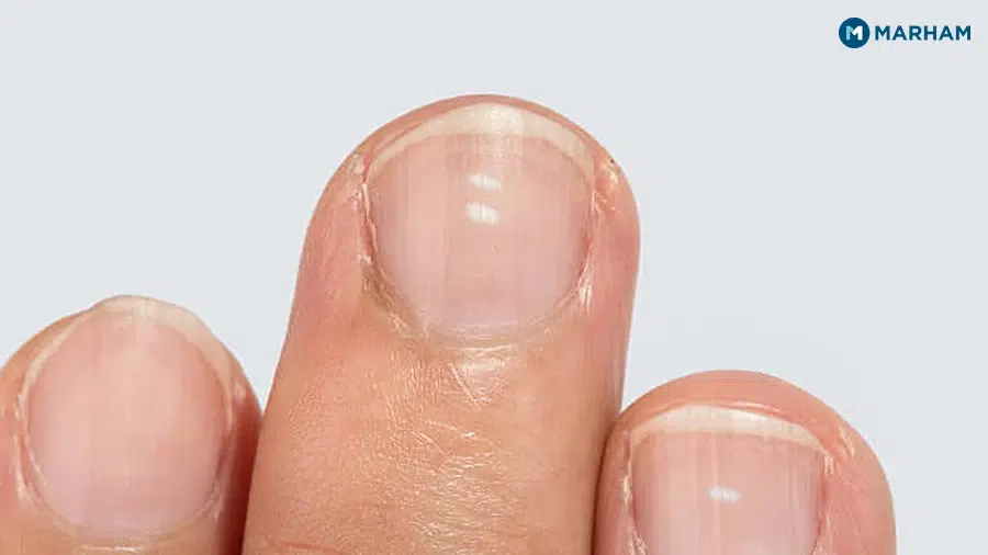 4. Fungal Nail Infection (Onychomycosis)