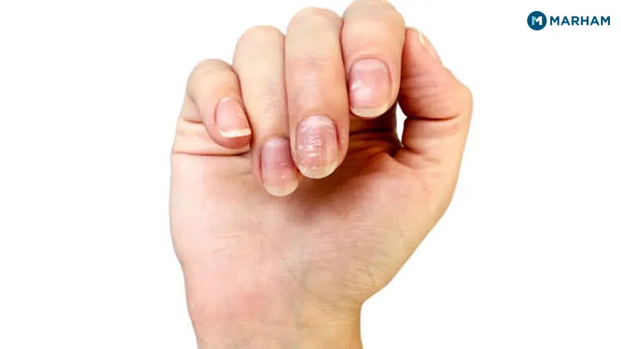 The Press Test: True vs Apparent Leukonychia