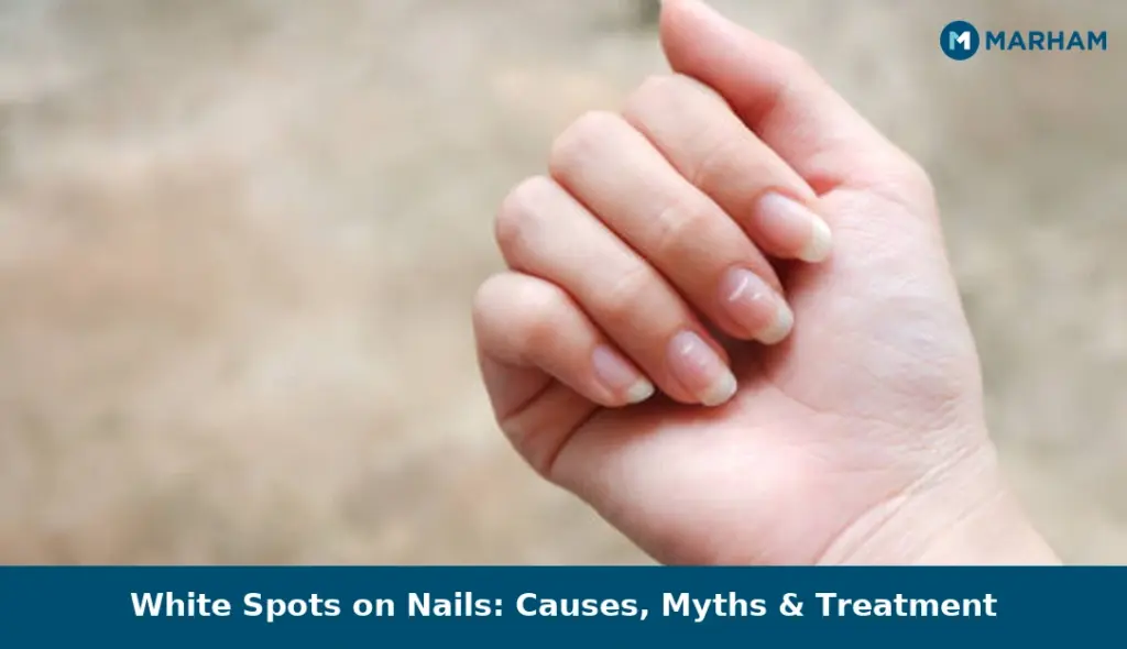 White Spots on Nails: Causes, Myths & Treatment