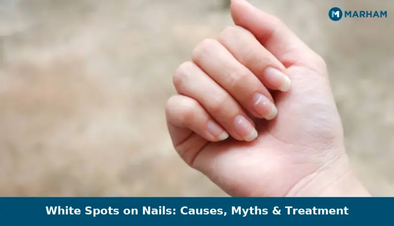 White Spots on Nails: Causes, Myths & Treatment