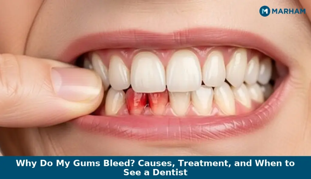 Why Do My Gums Bleed? Causes, Treatment, and When to See a Dentist