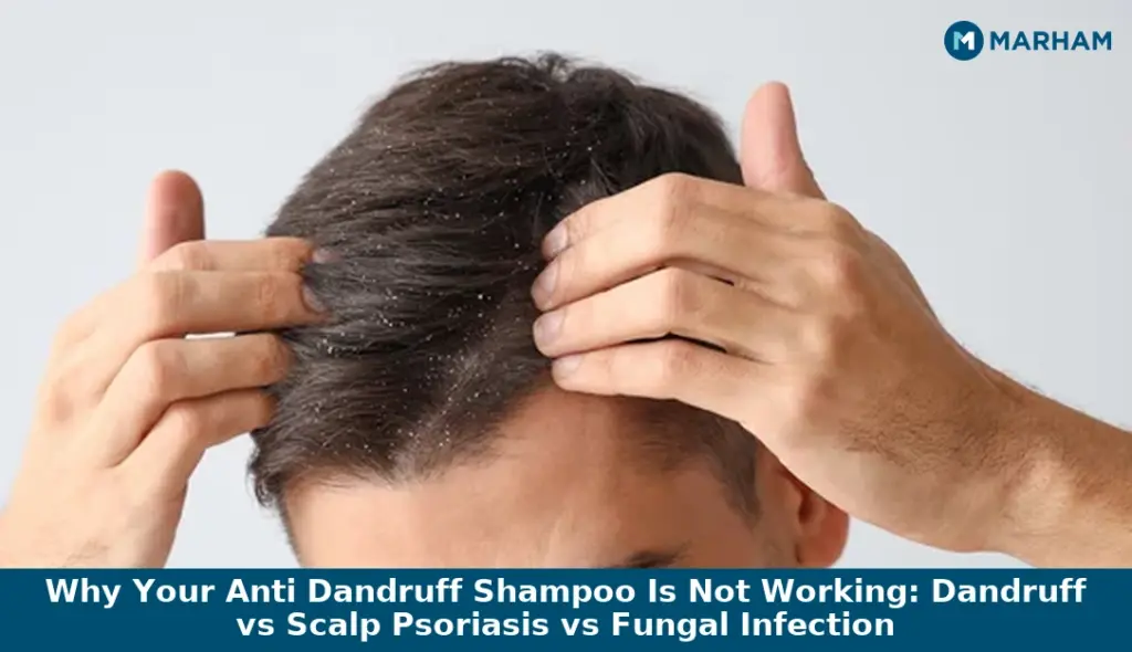 Why Your Anti Dandruff Shampoo Is Not Working: Dandruff vs Scalp Psoriasis vs Fungal Infection Why Your Anti Dandruff Shampoo Is Not Working: Dandruff vs Scalp Psoriasis vs Fungal Infection